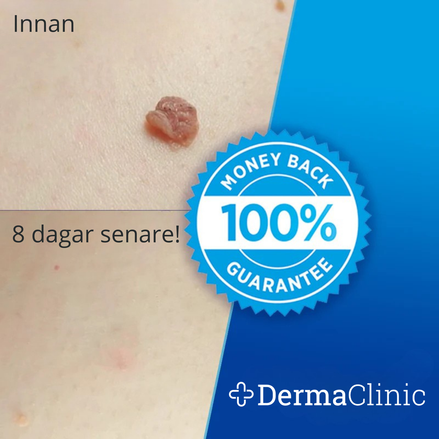 DermaTag™ - Smärtfri borttagning av hudflikar