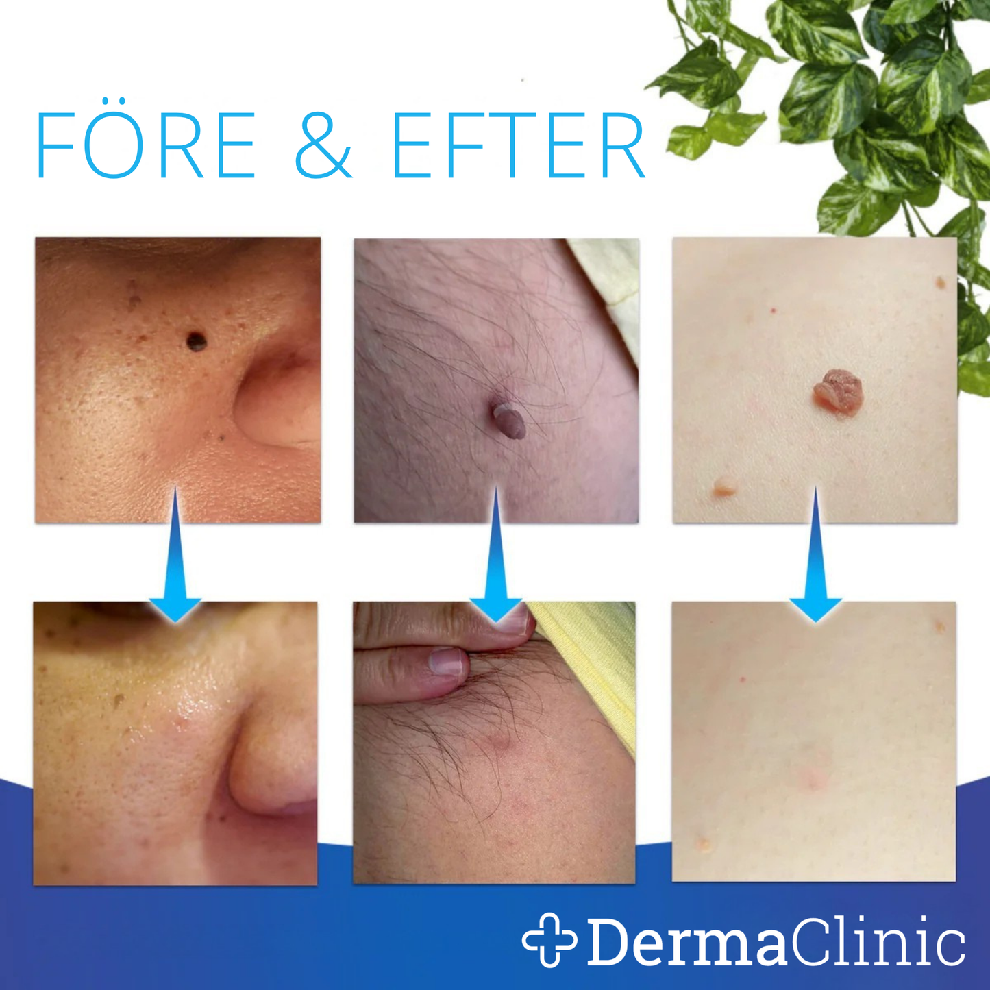 DermaTag™ - Smärtfri borttagning av hudflikar