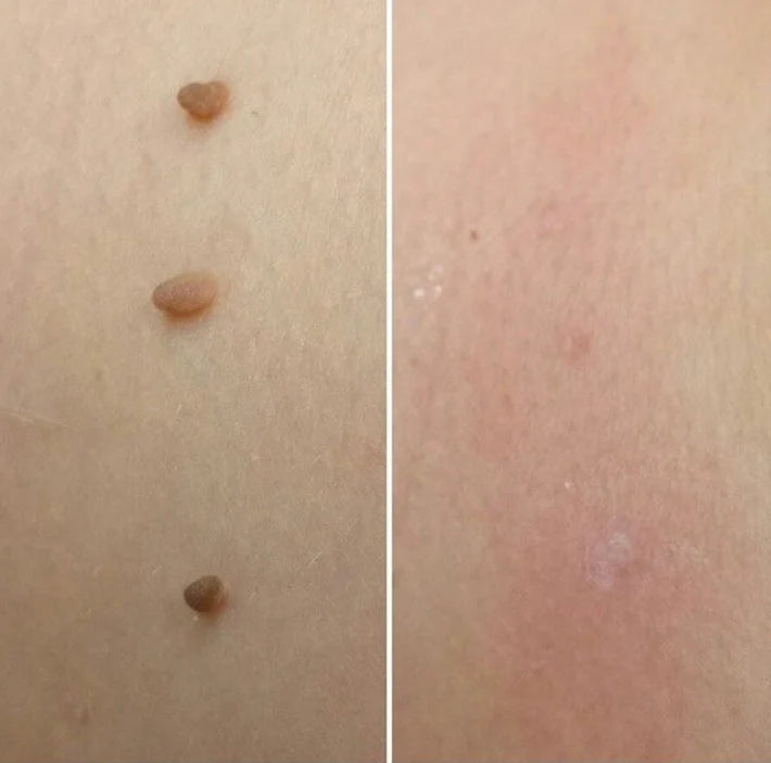 DermaTag™ - Smärtfri borttagning av hudflikar – DermaClinic